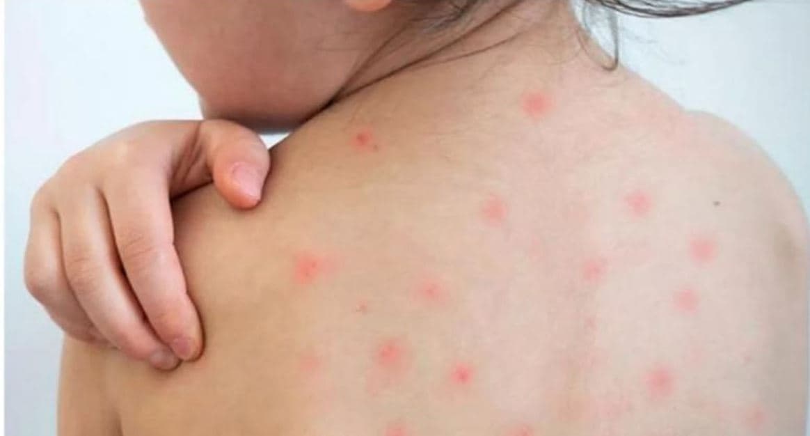 গত ২৪ ঘন্টায় সন্দেহজনক হাম রোগে  ৫ জনের মৃত্যু- খবরের থাম্বনেইল ফটো